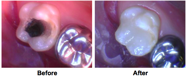 Heroic Dentistry: Saving Teeth with Bioactive Materials | Inside Dentistry
