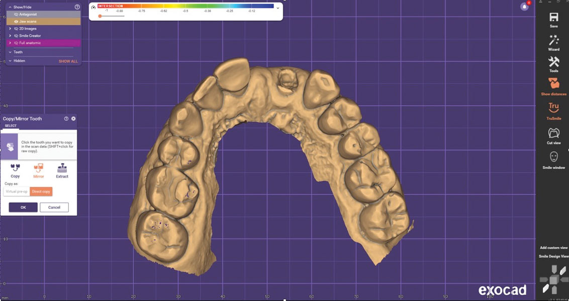 The Three Pillars of Successful Implant Planning | Inside Dentistry
